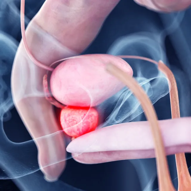 Cirugías de Próstata